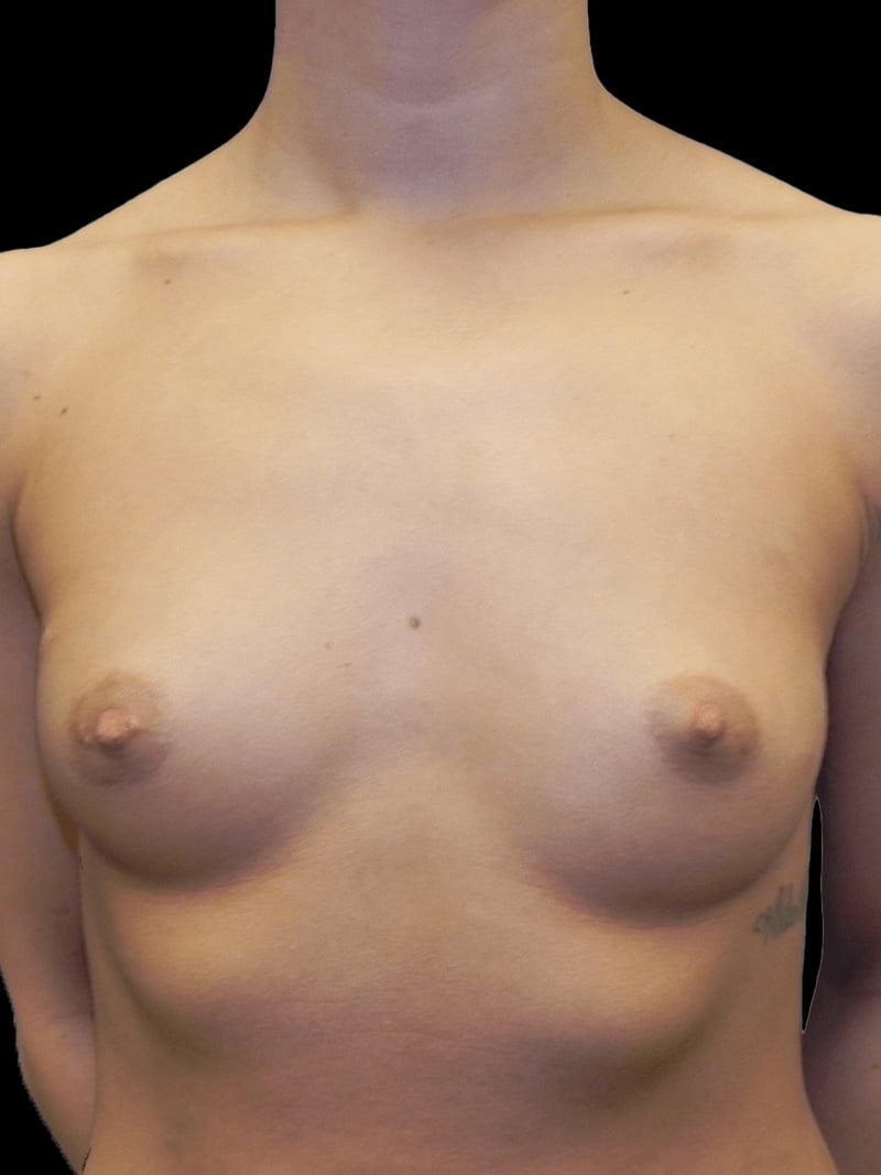 Breast Aug. Before 2