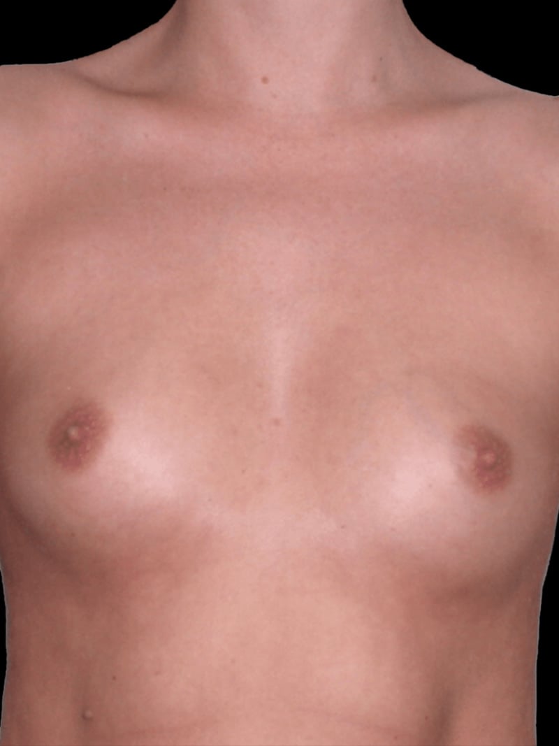 Breast Aug. Before 3