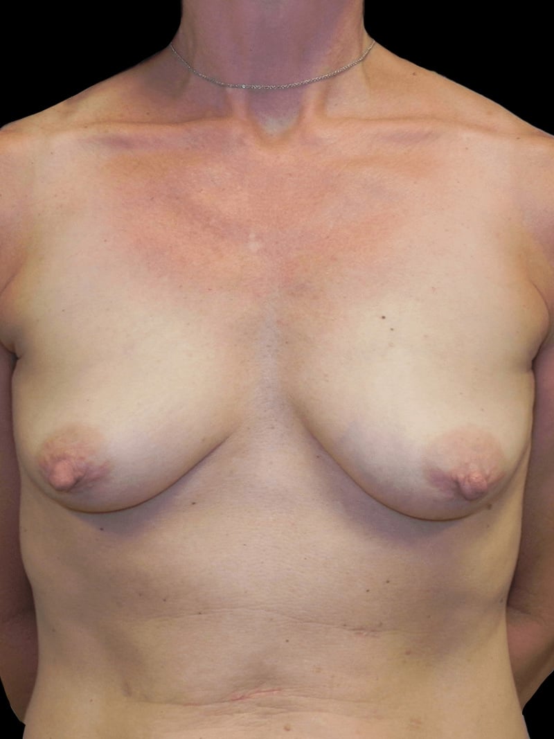 Direct to Implant Before 1