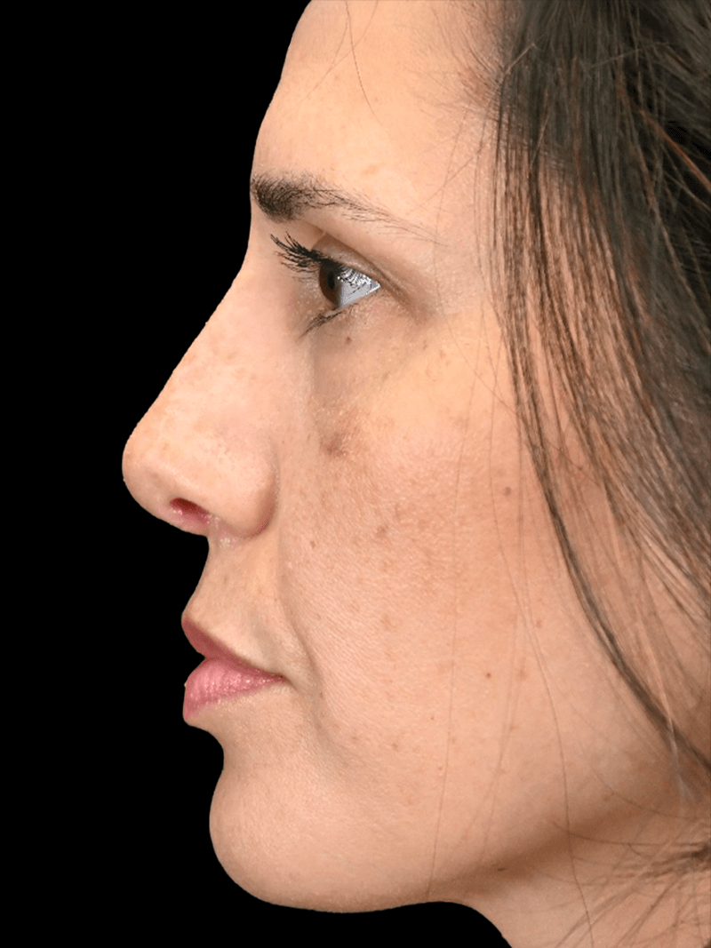 PRMA - Rhinoplasty - After Side L
