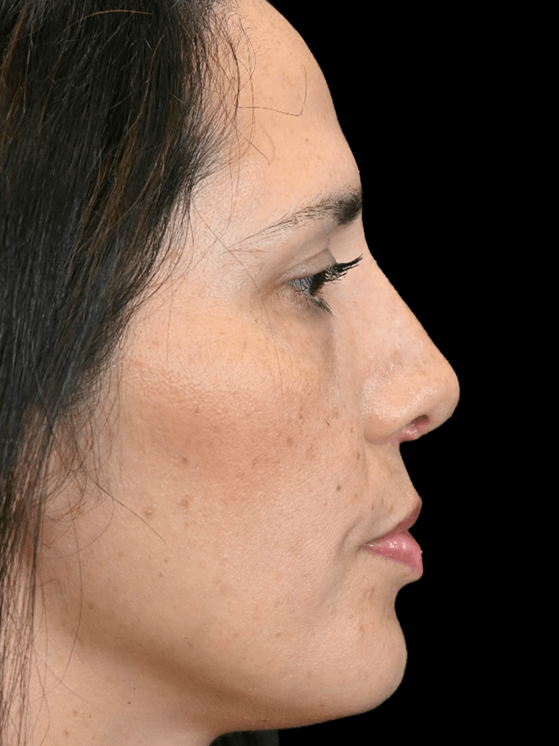 PRMA - Rhinoplasty - After Side R