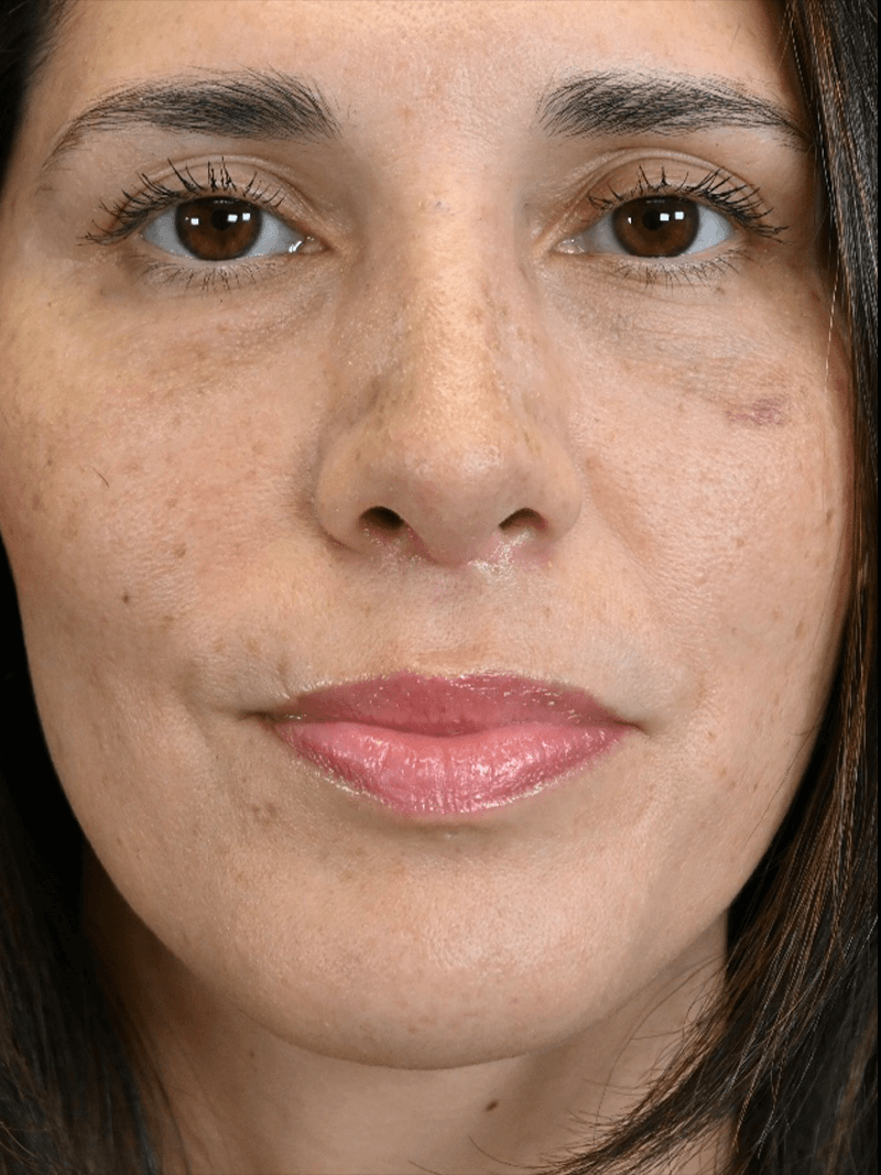 PRMA - Rhinoplasty - After