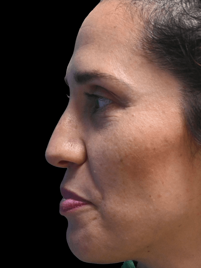 PRMA - Rhinoplasty - Before Side L