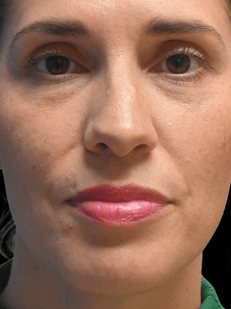 PRMA - Rhinoplasty - Before