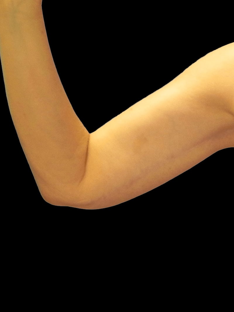 Brachioplasty After 2