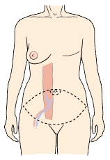 DIEP Flap Reconstruction in Ohio: Natural Breast Reconstruction