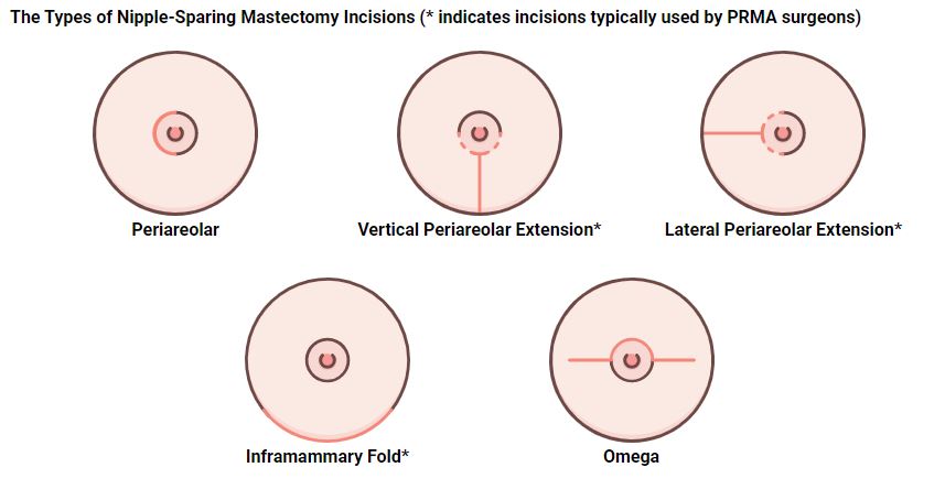 types of nipple sparing mastectomy incisions prma plastic surgery