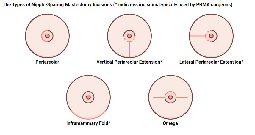 Nipple Sparing Mastectomy - PRMA