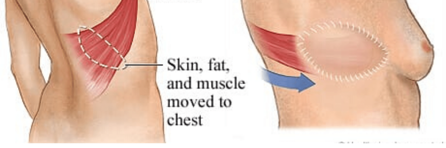 what is lat flap surgery
