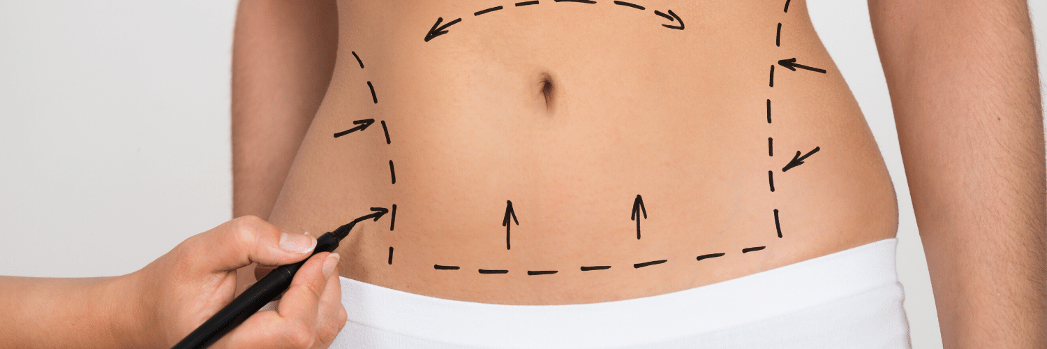 Is DIEP Flap Surgery the Same as a Tummy Tuck PRMA Plastic Surgery