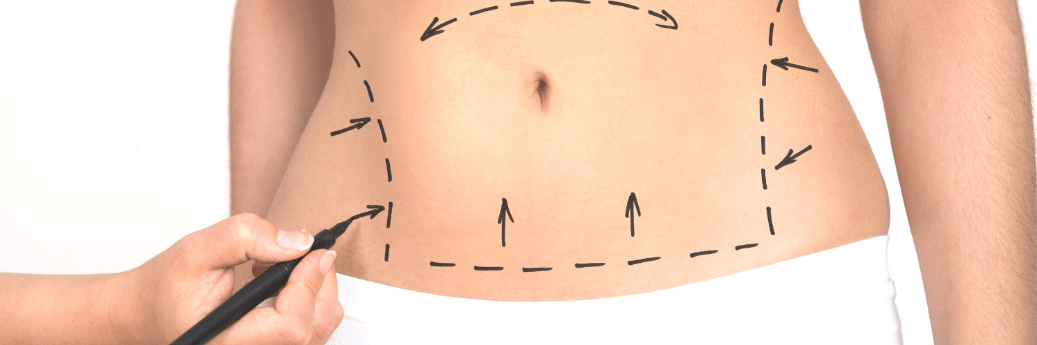 Tummy Tuck Pictures - Abdominoplasty