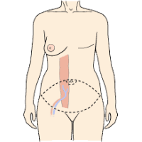 Schematic of the DIEP flap reconstructive surgery and postoperative