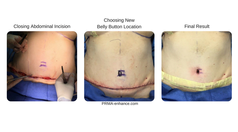 belly_button_diep_flap_breast_reconstruction