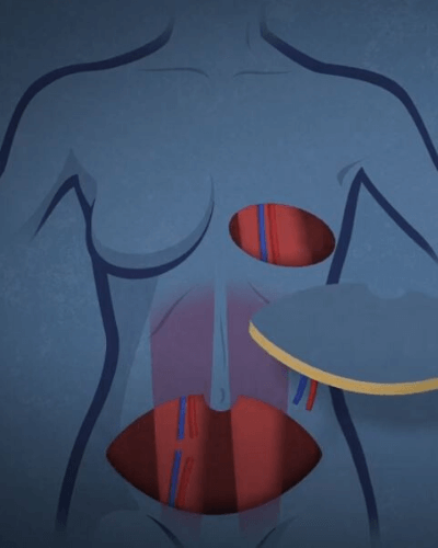 How a “New” Belly Button is Created During DIEP Flap Breast Reconstruction  - PRMA