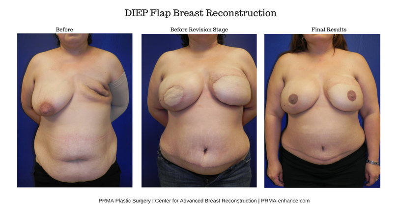 diep flap breast reconstruction between stages prma plastic surgery
