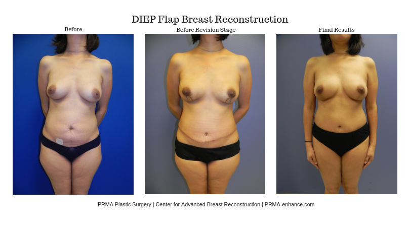 diep_flap_before_and_after_-_between_stages_-_prma_plastic_surgery