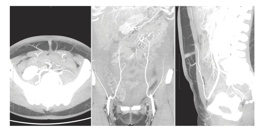 Can I Have DIEP Flap Breast Reconstruction After Prior Abdominal Surgery? -  PRMA