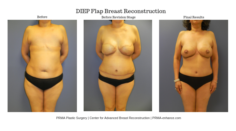 flat to diep flap breast reconstruction between stages prma plastic surgery