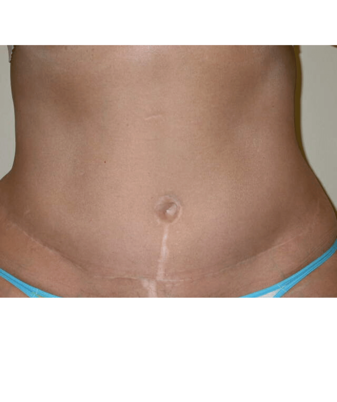 tummy-tuck-before-and-after-photos-after-prma-plastic-surgery-case-41