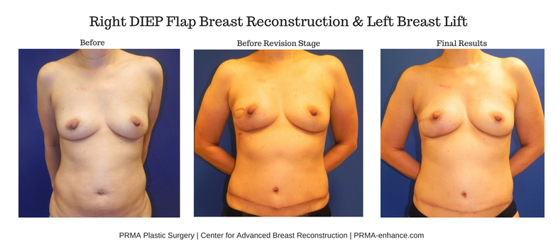 unilateral diep flap breast reconstruction between stages prma plastic surgery
