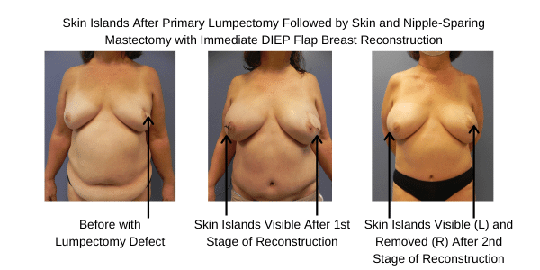 Skin Island Following DIEP Flap Surgery Expl 2