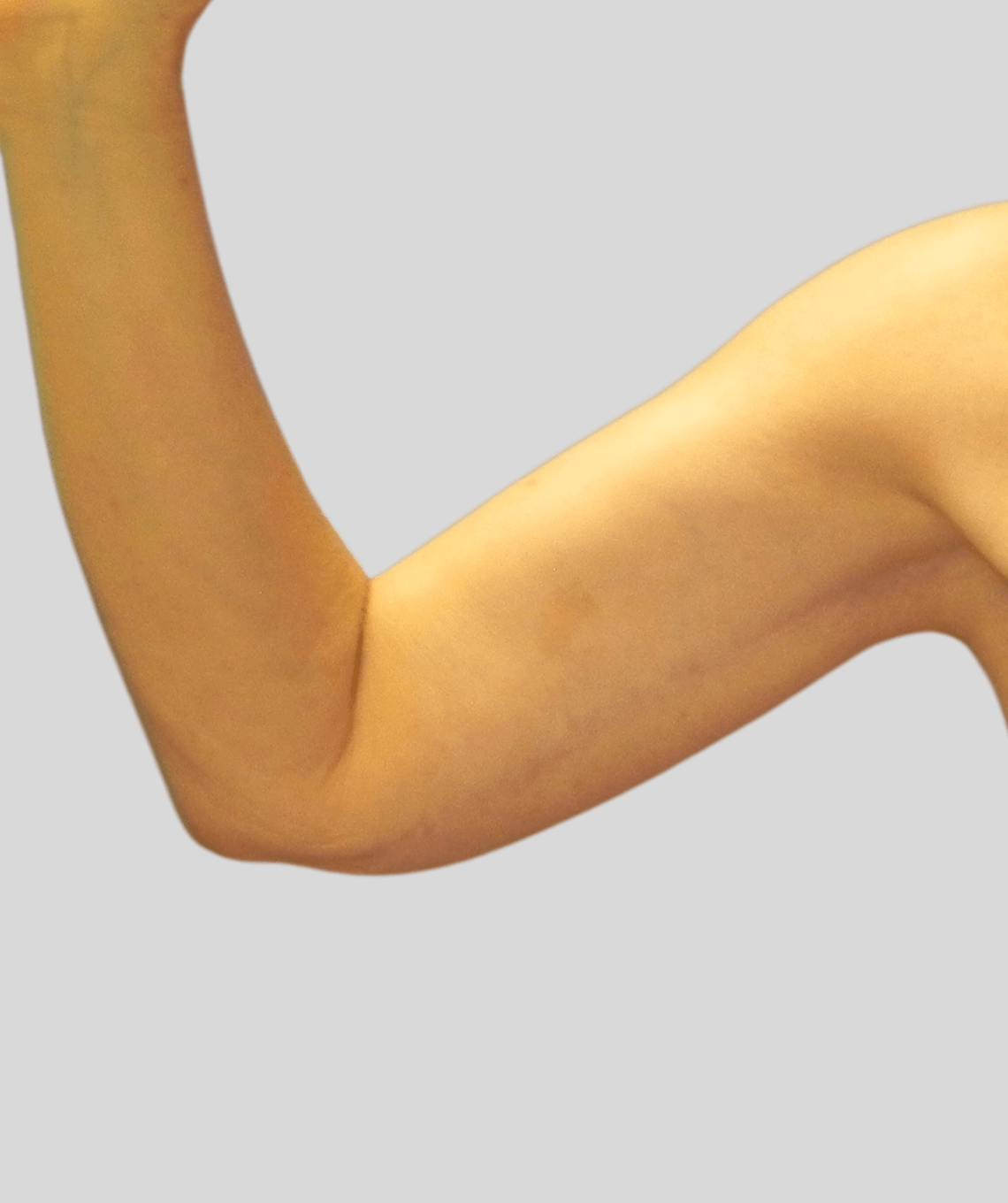 arm lift - before and after photos - after - prma plastic surgery - case 45