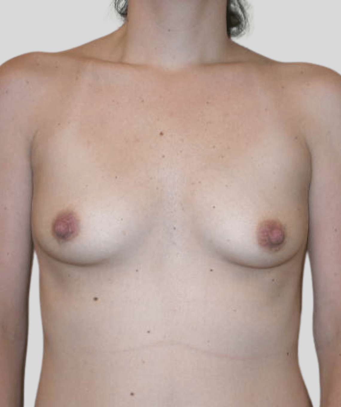 augmentation- before and after photos - before - prma plastic surgery - case 29