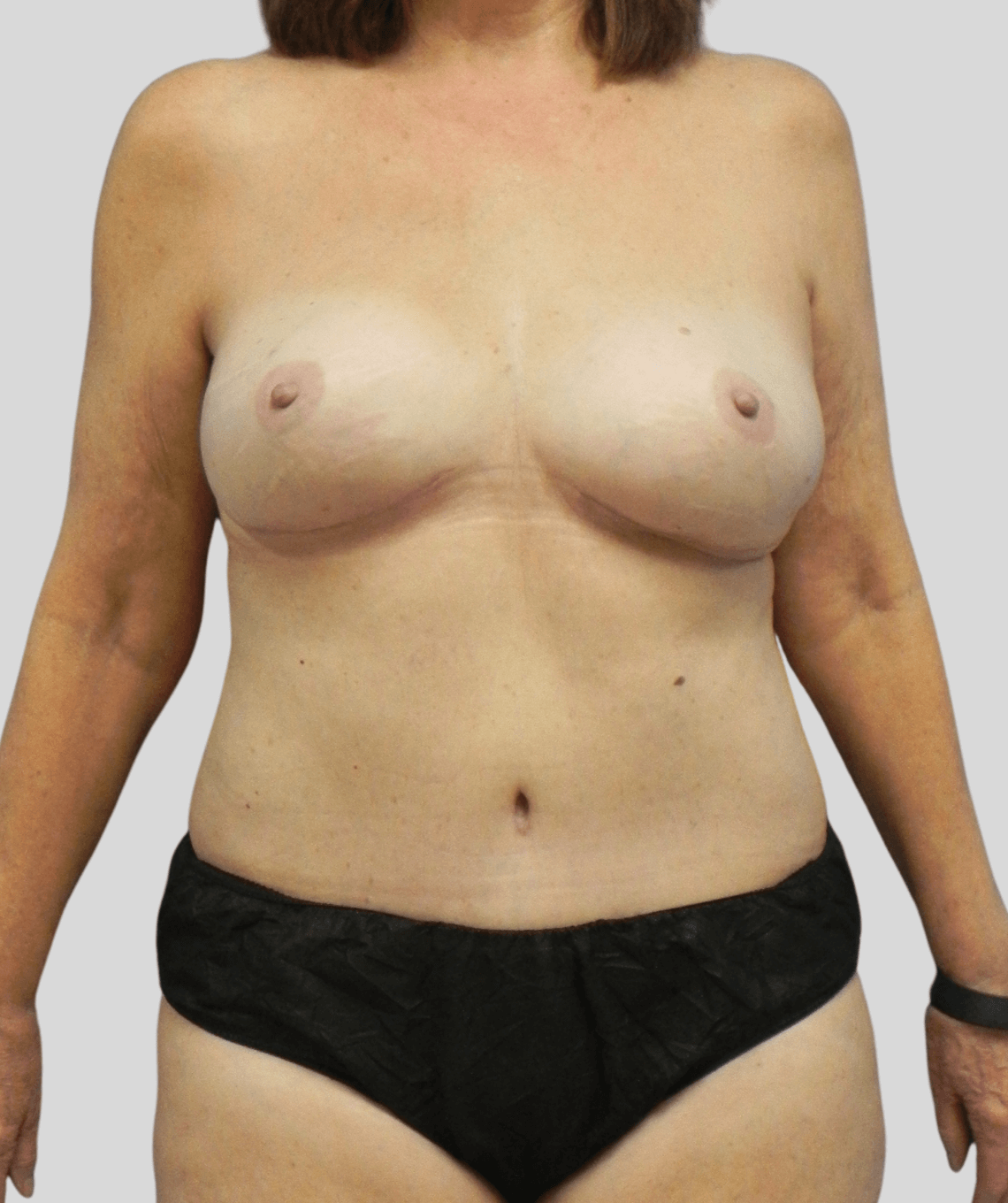 diep flap- before and after photos - after - prma plastic surgery - case 1