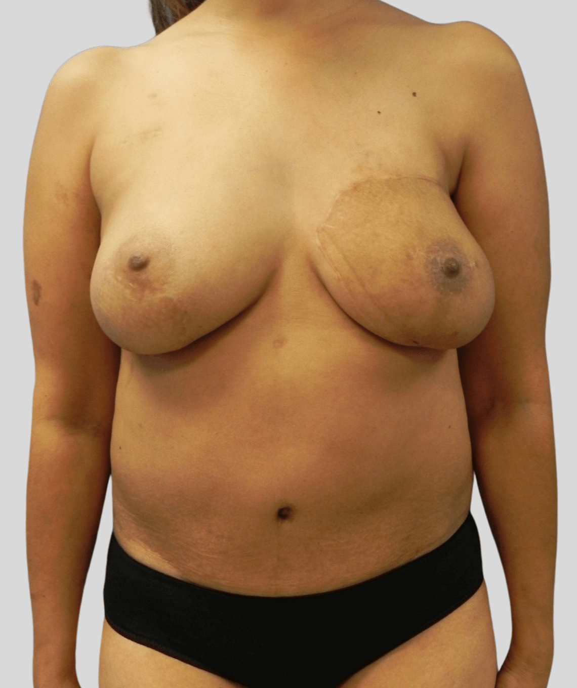 diep flap- before and after photos - after - prma plastic surgery - case 4