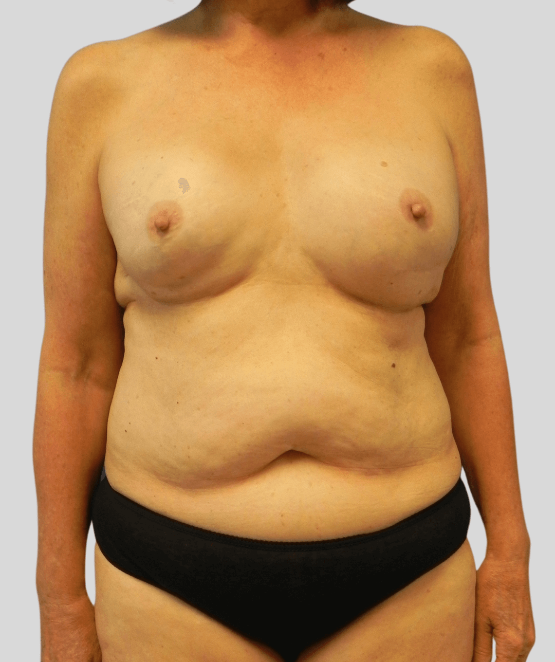 High Definition DIEP Flap Before & After Photos - PRMA