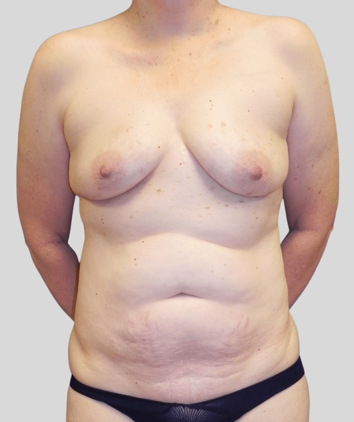 diep flap- before and after photos - before - prma plastic surgery - case 10