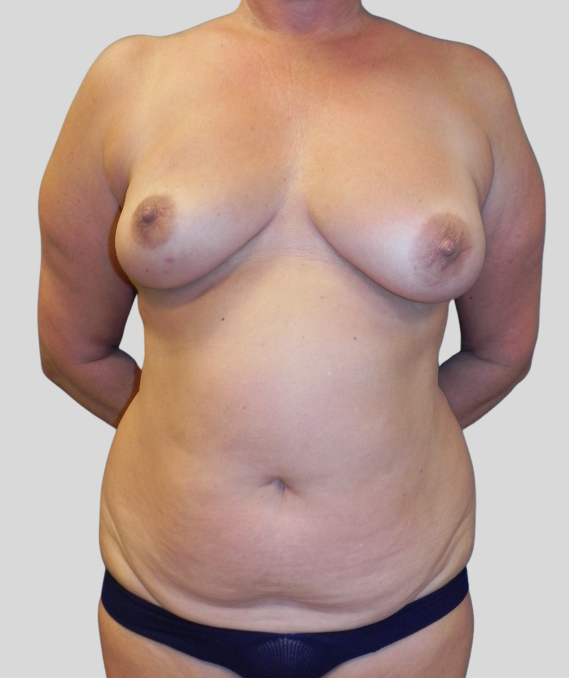diep flap- before and after photos - before - prma plastic surgery - case 11