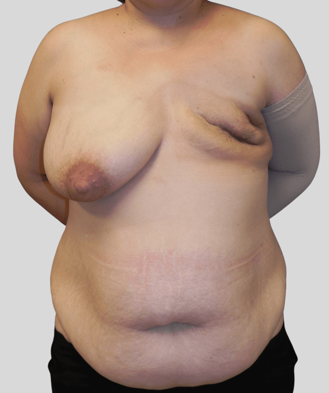 diep flap- before and after photos - before - prma plastic surgery - case 14
