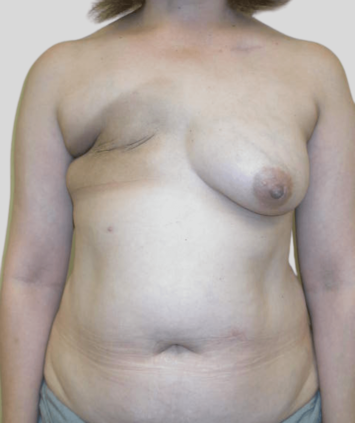 diep flap- before and after photos - before - prma plastic surgery - case 15