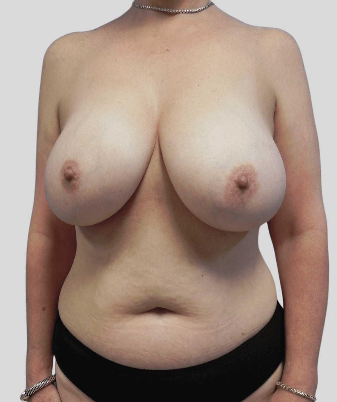 diep flap- before and after photos - before - prma plastic surgery - case 47