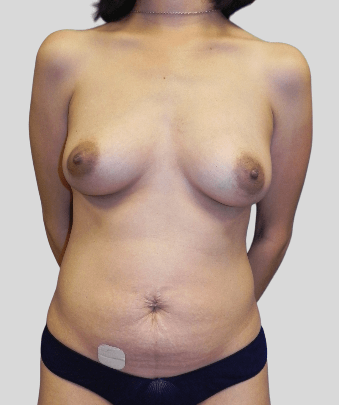 diep flap- before and after photos - before - prma plastic surgery - case 5