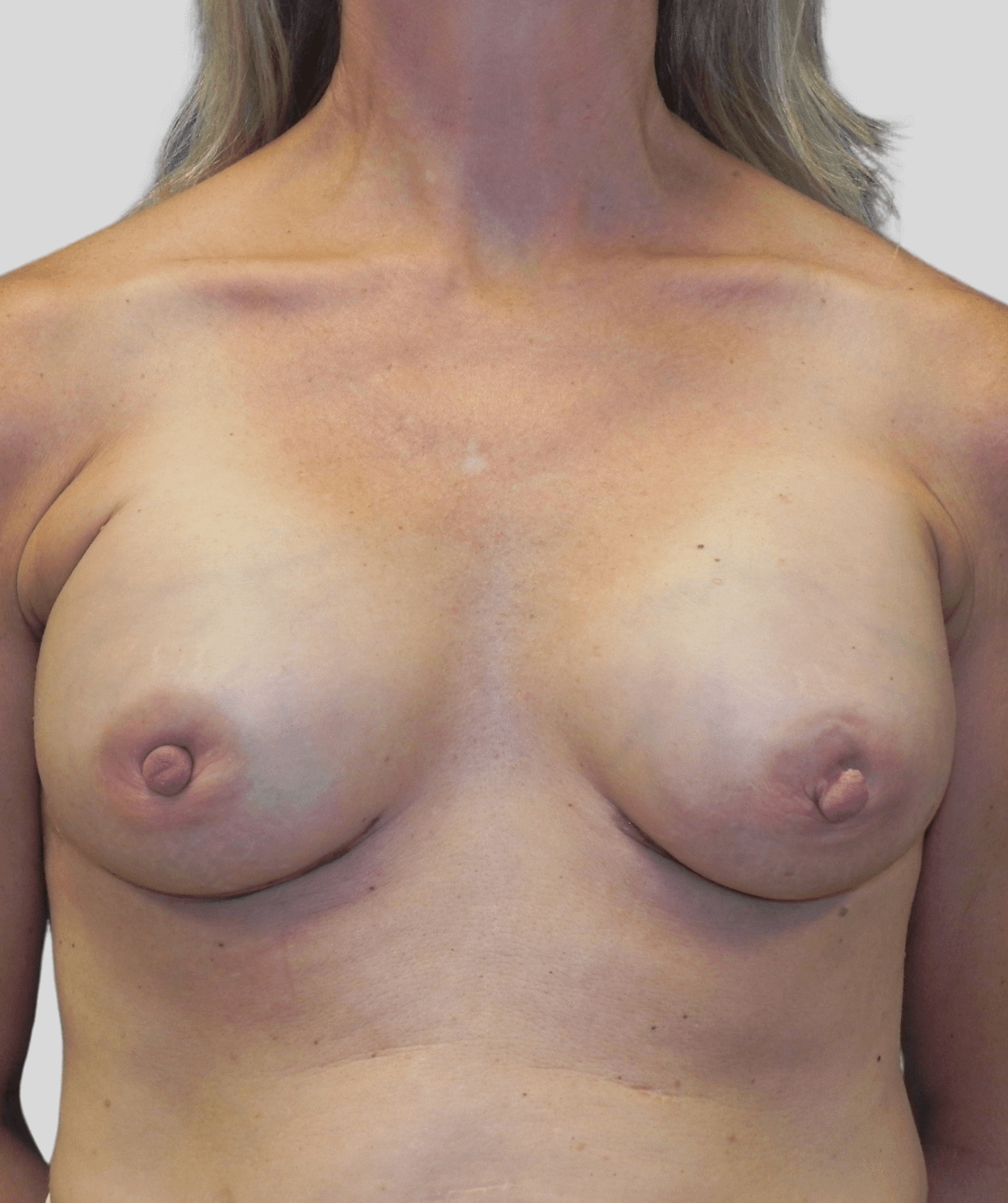 direct to implant- before and after photos - after - prma plastic surgery - case 26