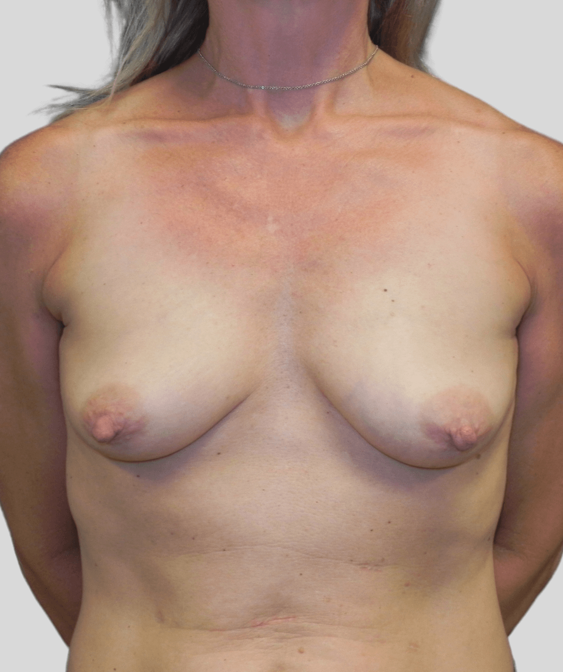 nipple sparing mastectomy with direct to implant breast reconstruction - before and after photos - prma plastic surgery - case 26