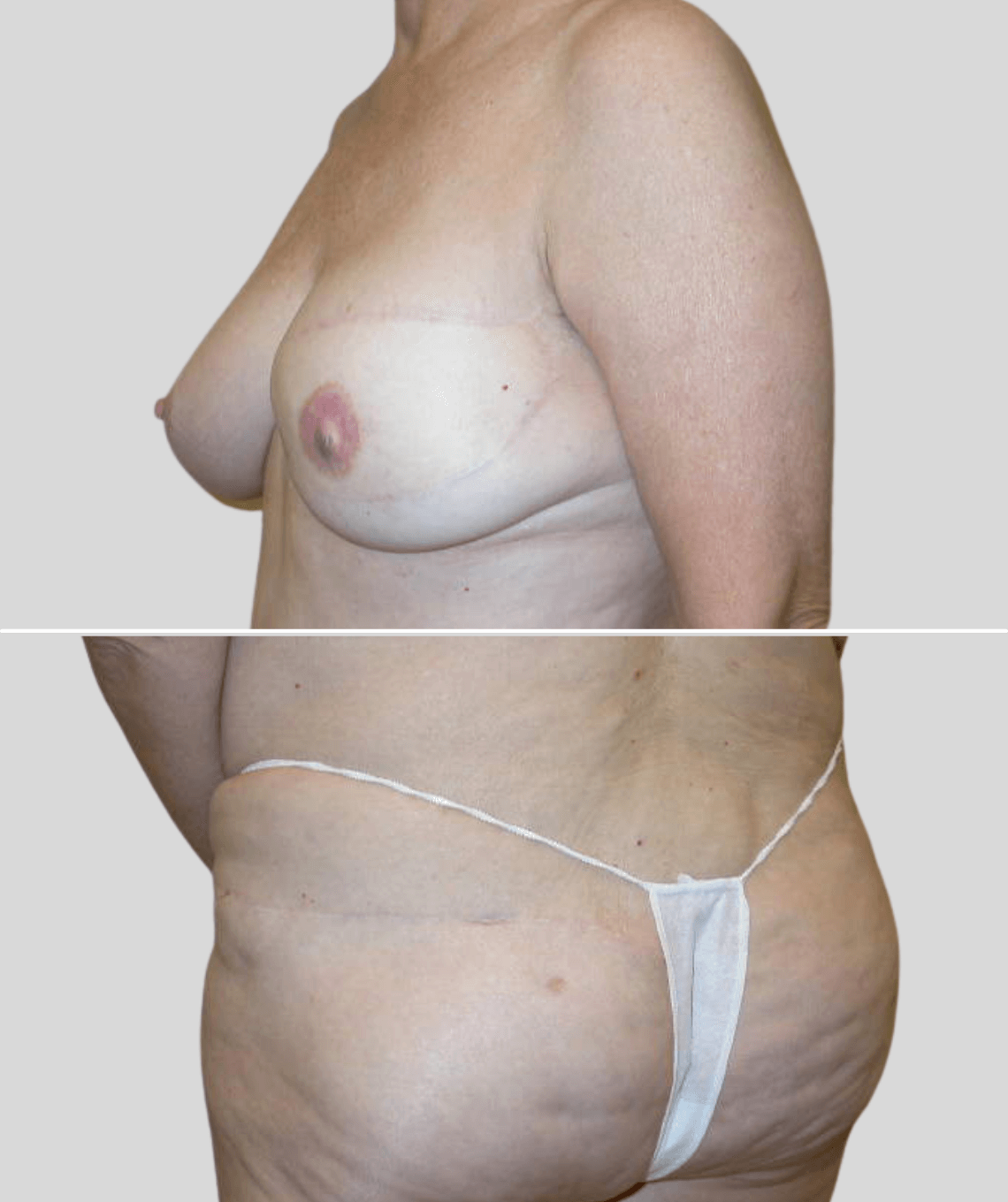 gap flap- before and after photos - after - prma plastic surgery - case 16