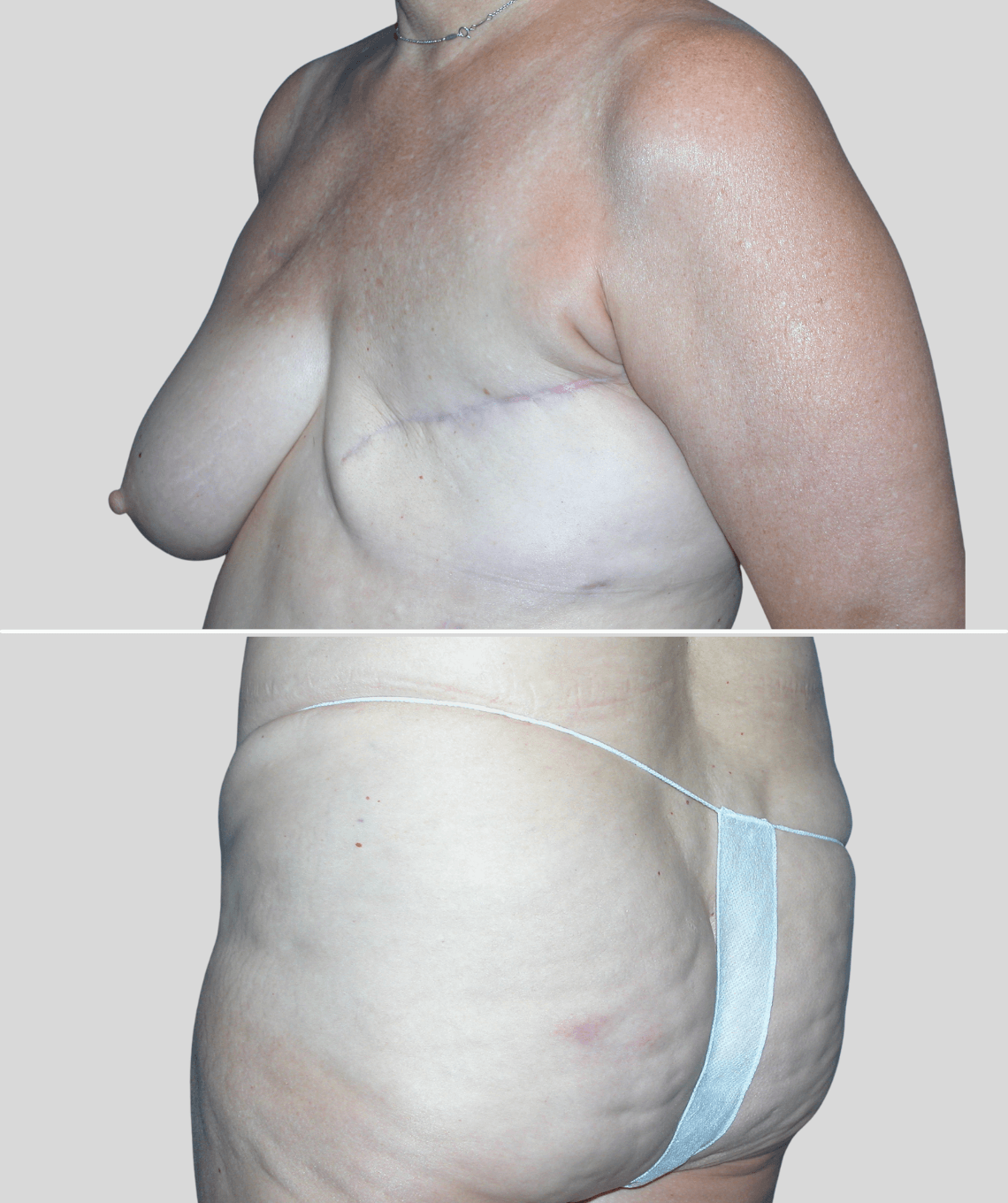 gap flap- before and after photos - before - prma plastic surgery - case 16