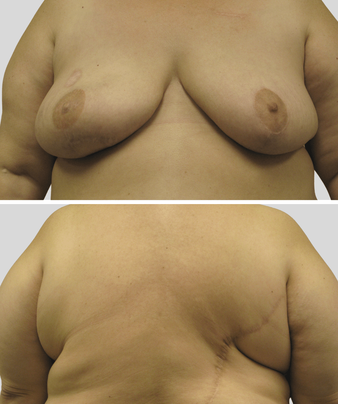 lat flap- before and after photos - after - prma plastic surgery - case 19