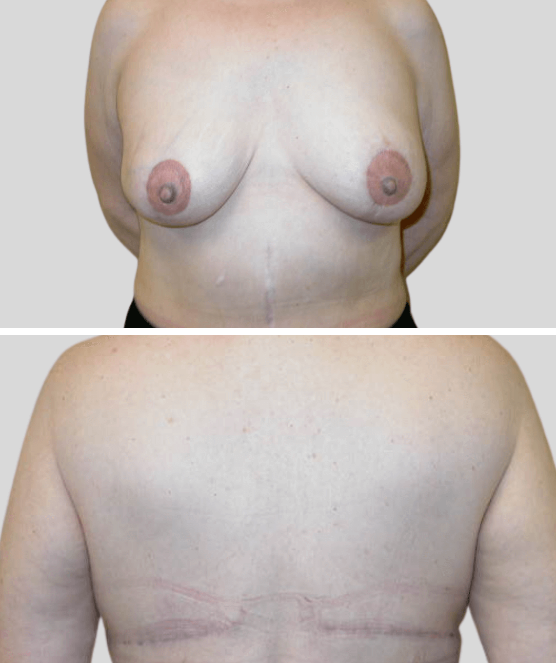 lat flap- before and after photos - after - prma plastic surgery - case 20
