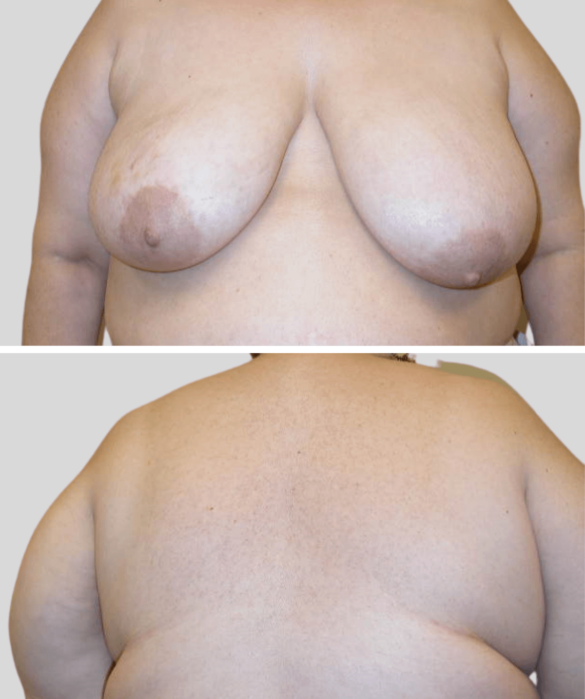 lat flap- before and after photos - before - prma plastic surgery - case 19