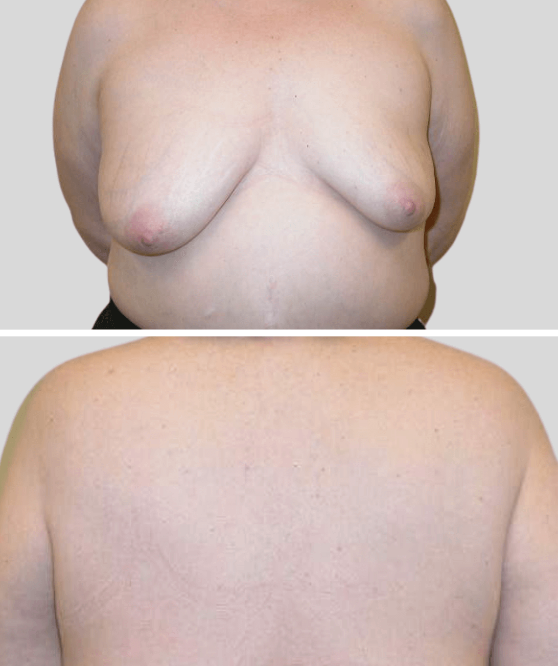 lat flap- before and after photos - before - prma plastic surgery - case 20