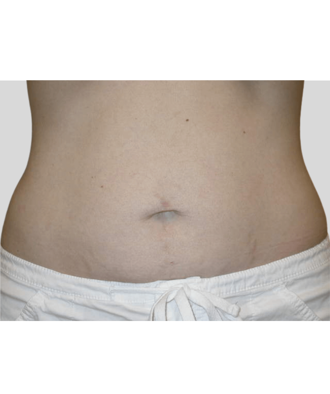 lipo - before and after photos - after - prma plastic surgery - case 44