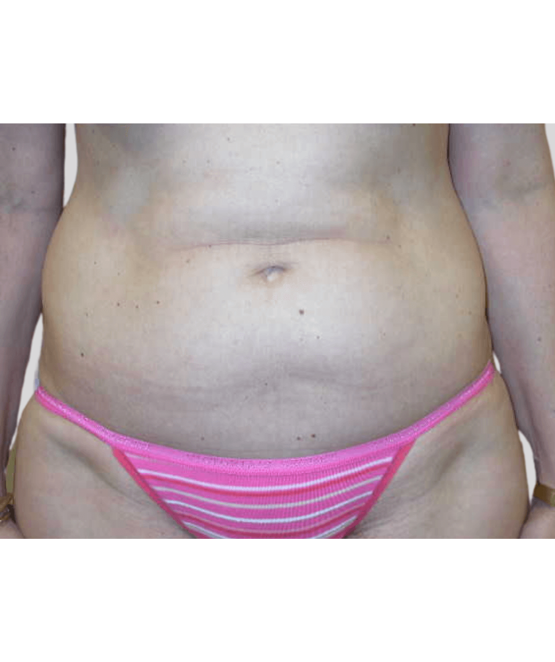 liposuction - before and after photos - prma plastic surgery - case 42