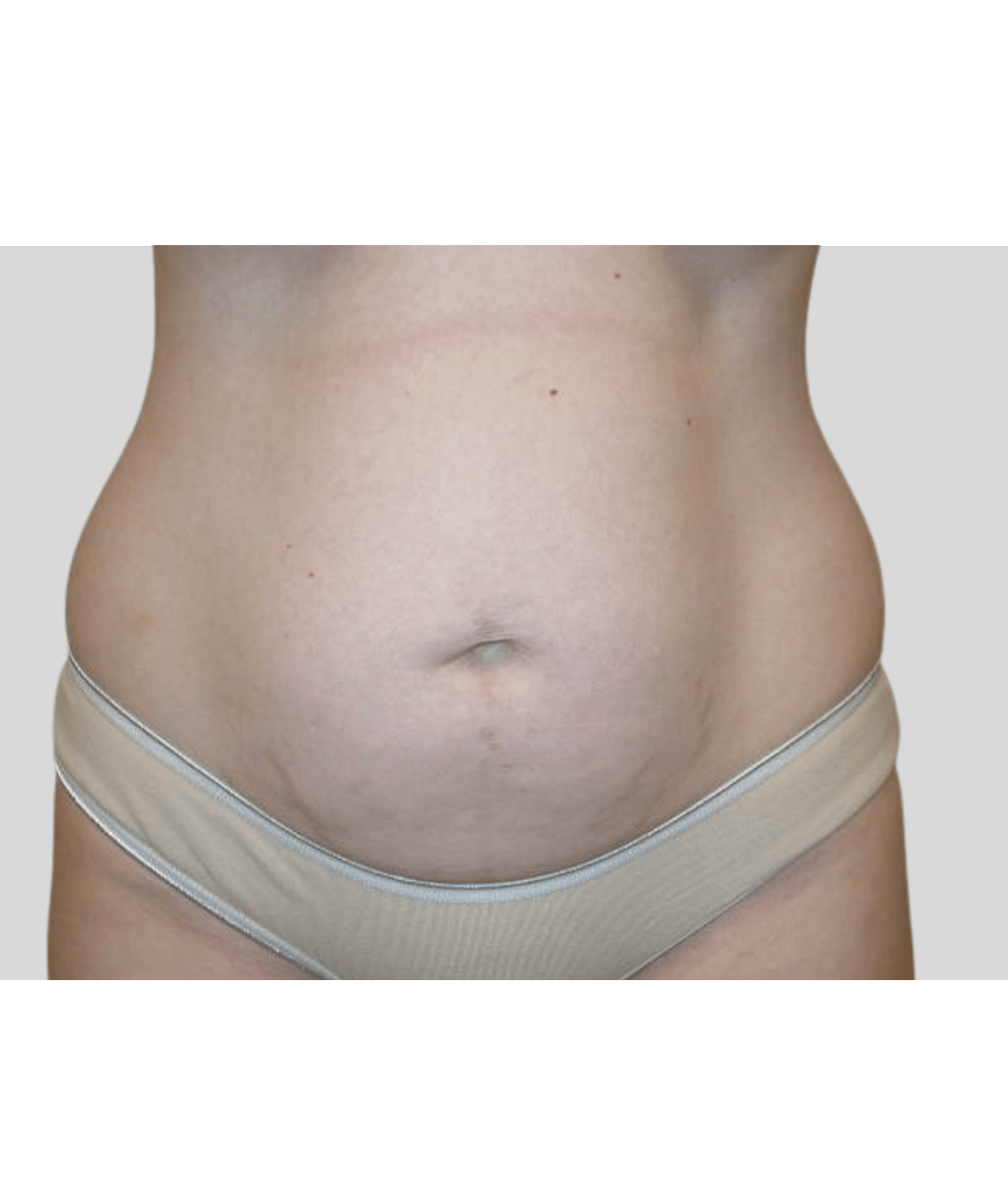 liposuction - before and after photos - prma plastic surgery - case 43