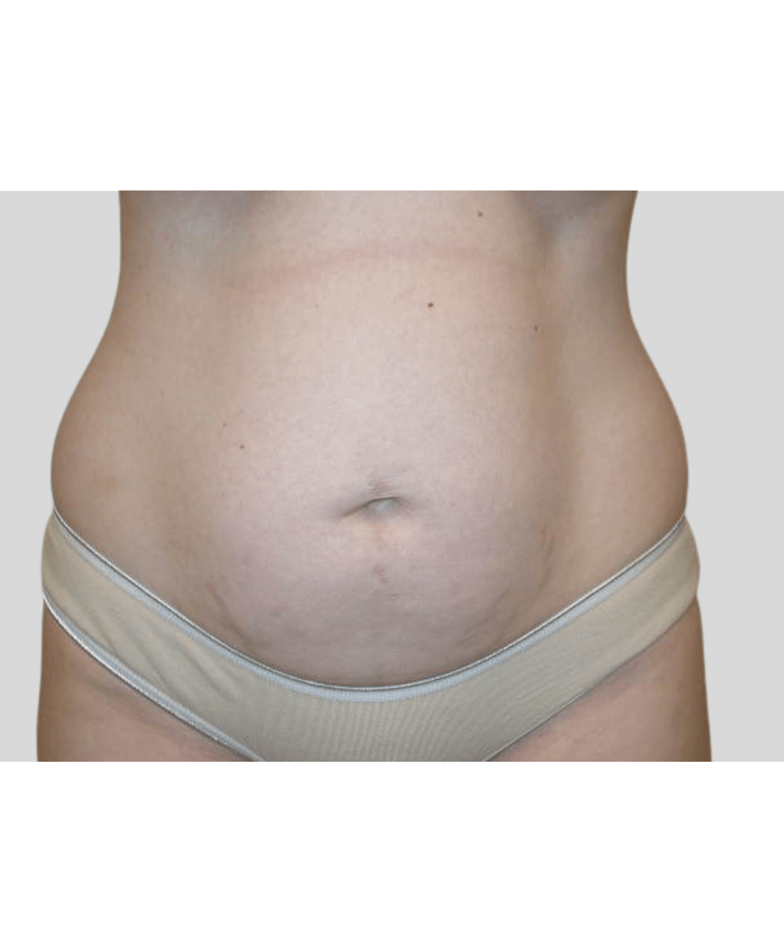 lipo - before and after photos - before - prma plastic surgery - case 43