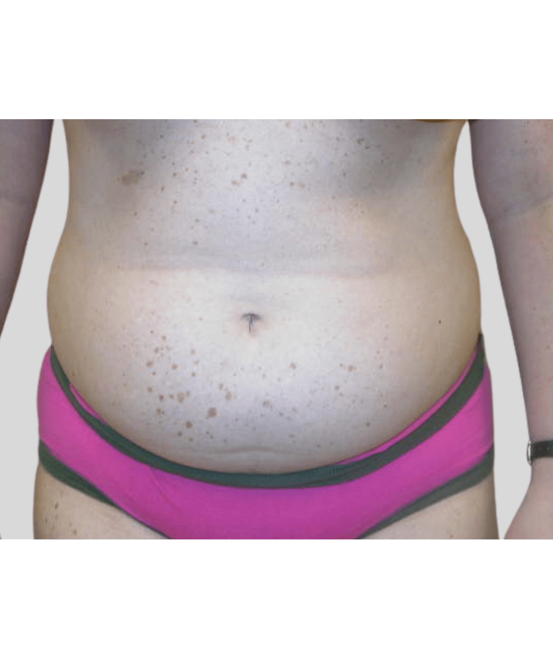 lipo - before and after photos - before - prma plastic surgery - case 44