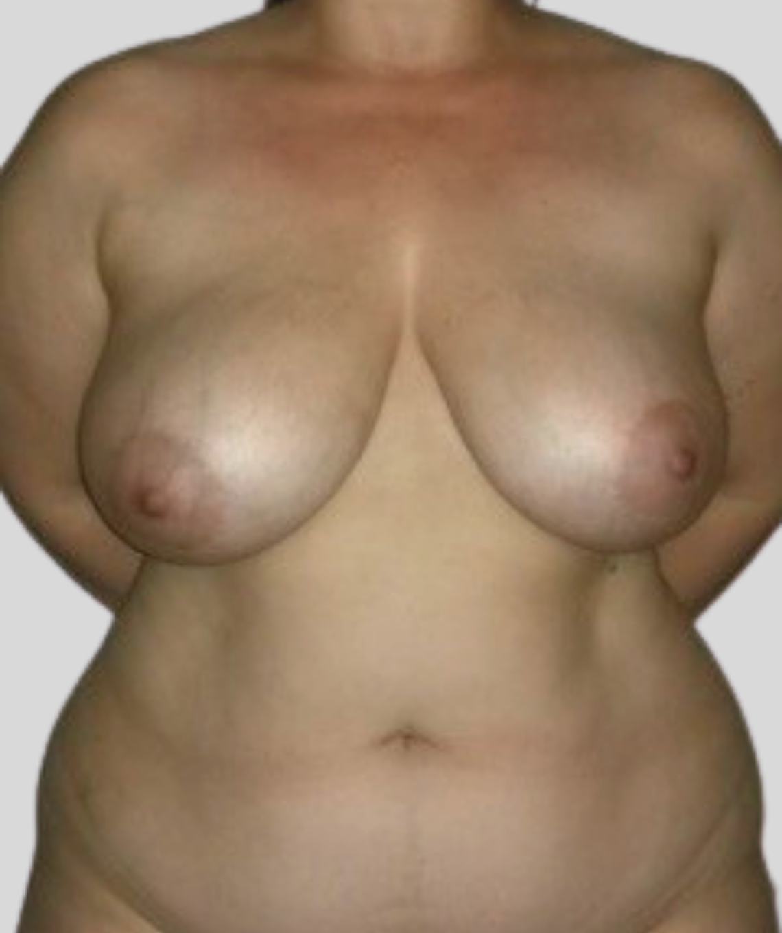 DIEP - before and after photos - before - prma plastic surgery - case 000